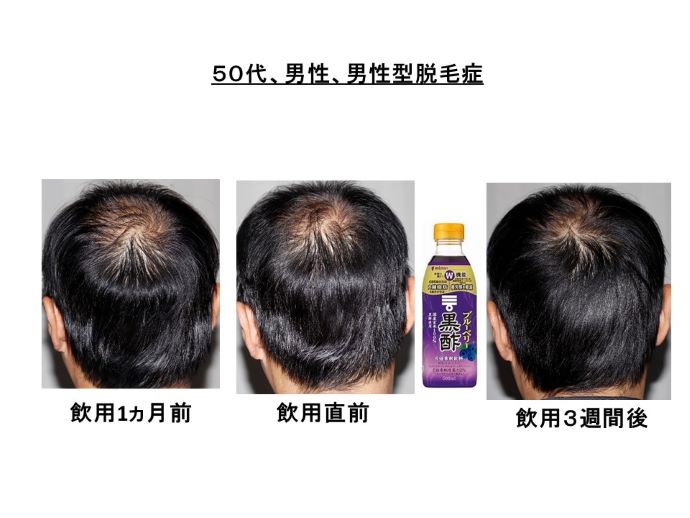 円形脱毛症　病院